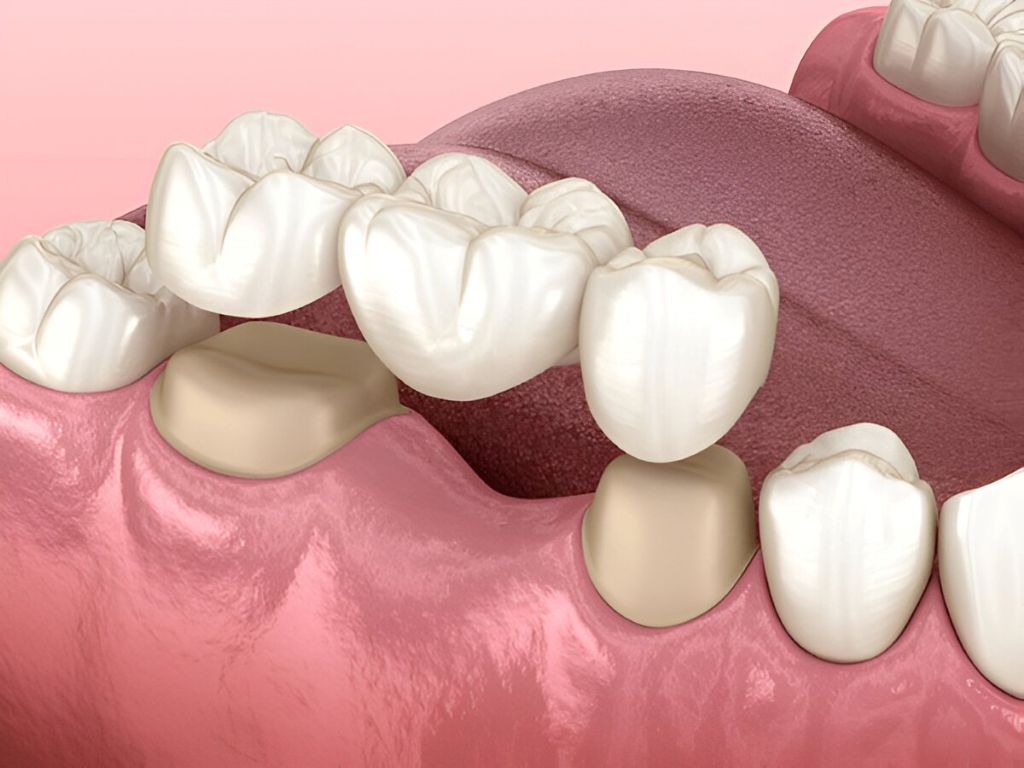 dental bridges In surrey bc