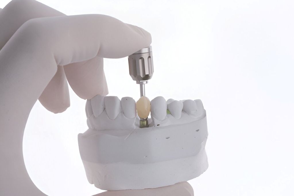 dental crowns In surrey, bc