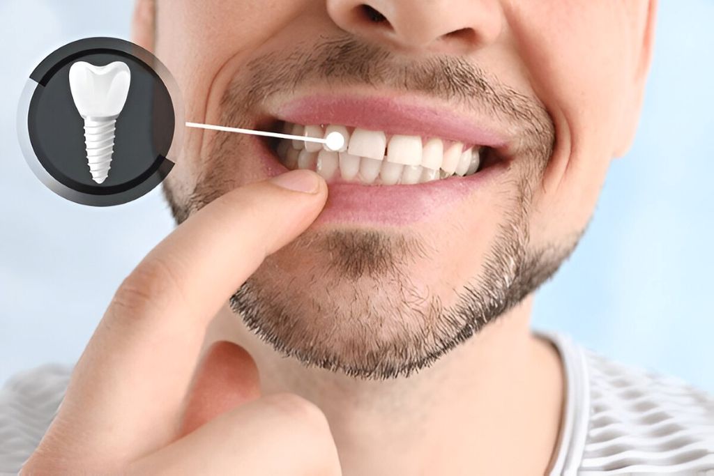 dental implants in surrey, bc
