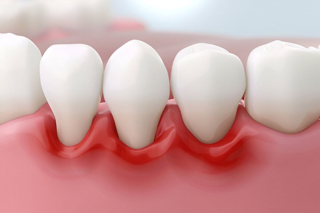 gum recession near you
