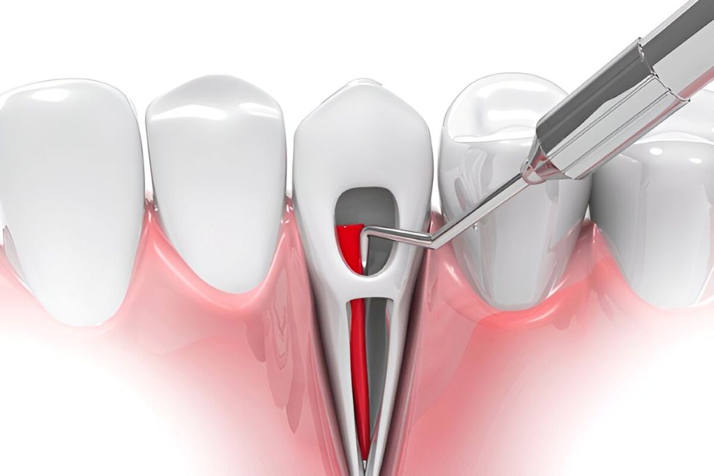root canal treatment near you