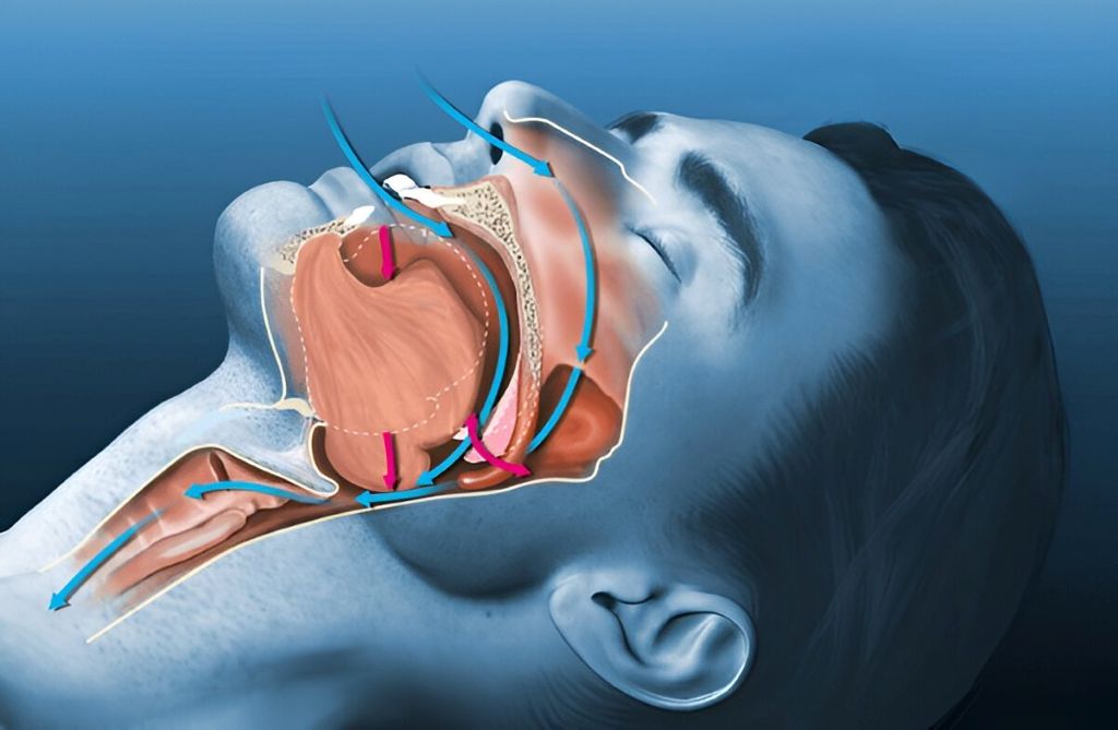 sleep apnea and snoring in surrey, bc