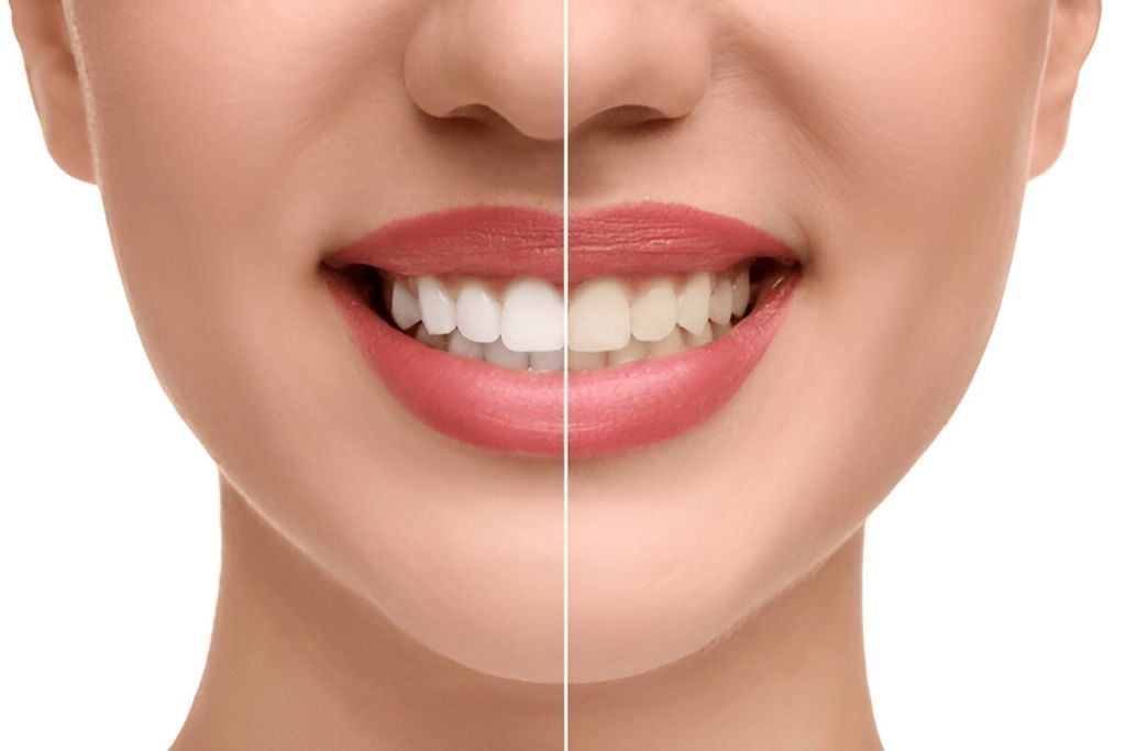 teeth whitening near you