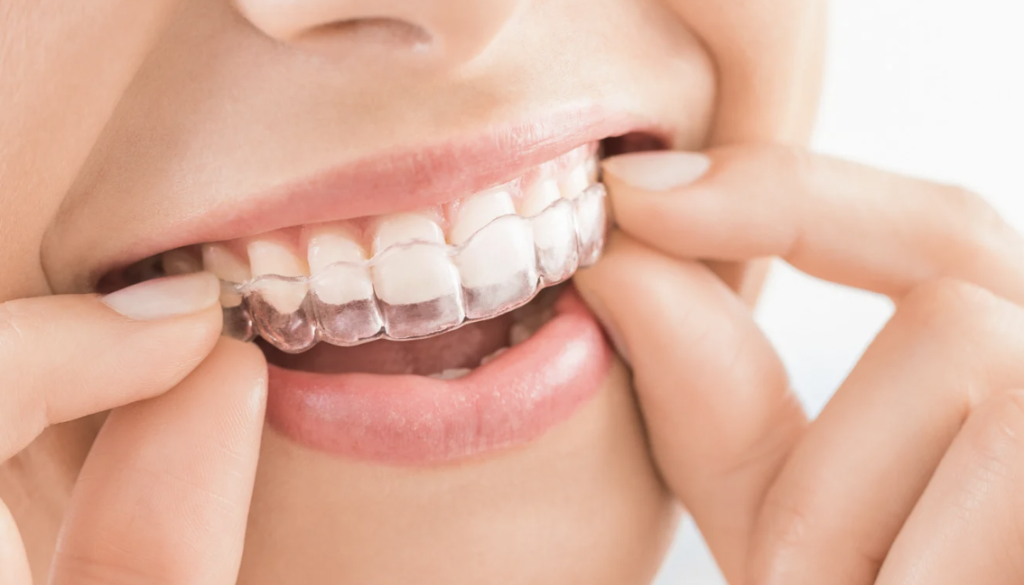 why invisalign could be a good fit for you